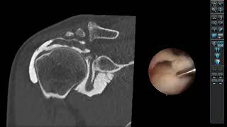 Comment janalyse et jinterprète un arthroscanner de lépaule [upl. by Akemit]