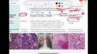 Squamous cell carcinoma of lung Respiratory 55  First Aid USMLE Step 1 in UrduHindi [upl. by Aehcim768]