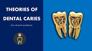 Theories of Dental Caries [upl. by Heddie]