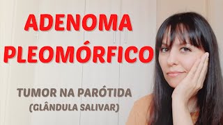 Adenoma pleomórfico tumor na parótida glândula salivar [upl. by Showker]