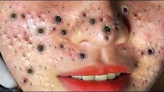 Big Cystic Acne Blackheads Extraction Blackheads amp Milia Whiteheads Removal Pimple Popping  614 [upl. by Ateloiv]