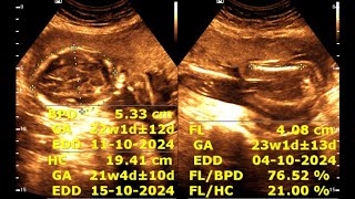 Routine antenatal ultrasound at 21 weeks gestation  Ultrasonography of a 21week pregnancy [upl. by Fife]