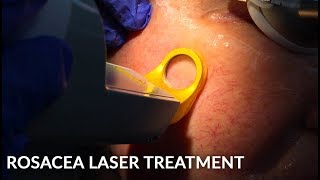 Treating Rosacea with Vascular Laser Excel V  Live [upl. by Adnolehs]