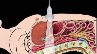 Introduction Abdominal Aorta Focused Ultrasound Examination [upl. by Jennings]