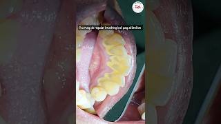 Is dental scaling harmful dentalscaling toothcleaning [upl. by Hardman639]