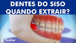 Pericoronarite e extração de dentes do siso © [upl. by Anair]