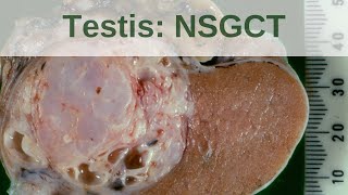 Testicular germ cell tumours  Non seminomatous germ cell tumours  Pathology mini tutorial [upl. by Hilliary711]