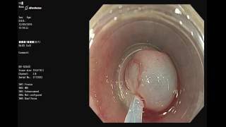 食道肌瘤切除術 Esophageal EMR Endoscopic Mucosal Resection  for leiomyoma [upl. by Gaillard]