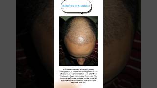 Finasteride for hair loss in androgenic alopecia [upl. by Ahter]