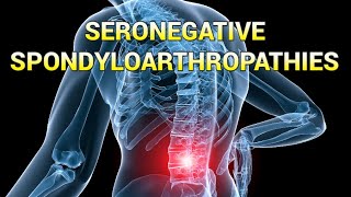 Seronegative Spondyloarthropathies updated 2023  CRASH Medical Review Series [upl. by Akimak38]