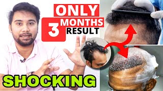 This 3 Months Hair Transplant Result Will Shock You  Natural Looking Hairline By Hair Transplant [upl. by Etteuqaj]