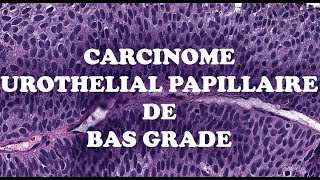 LE CARCINOME UROTHELIAL PAPILLAIRE DE BAS GRADE – PATHOLOGIE [upl. by Essined]