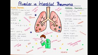 Alveolar vs Interstitial Pneumonia comparison [upl. by Hinch]