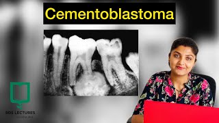 Cementoblastoma  Odontogenic Tumour  Lecture  24  Oral Pathology [upl. by Alda575]