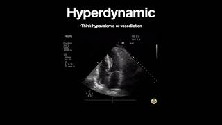 Hyperdynamic Left Ventricle Apical [upl. by Lemor]