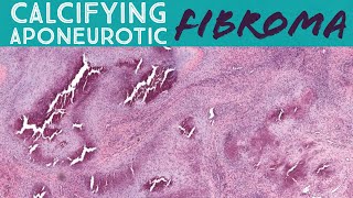 Calcifying Aponeurotic Fibroma UNC Case 5 pathology dermatopathology soft tissue tumor [upl. by Itsirk]