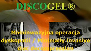 DISCOGEL® MAŁOINWAZYJNE PRZEZSKÓRNE LECZENIE DYSKPATII [upl. by Ribaj542]