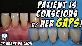 Closing The Patients Gaps with Direct Composite Technique C24 [upl. by Teerprah]