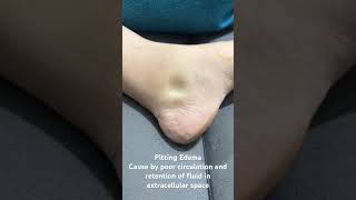 Edema pitting Edema cause by poor circulation and retention of fluid in extra cellular space [upl. by Meirrak]