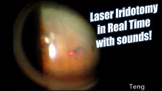 Laser Iridotomy in Real Time with Laser Sounds Chris Teng MD [upl. by Alleirbag]