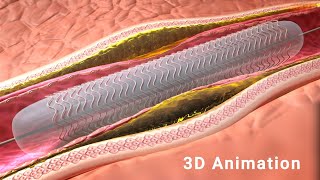 Balloon Angioplasty Procedure  3D Animation [upl. by Queena388]