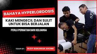 BAHAYA HYPERLORDOSIS I Terapi By Ahong [upl. by Asilrak241]