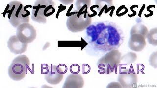 Intracellular YeastFungus on Peripheral Blood Smear Histoplasmosis Hematology Microbiology [upl. by Turrell]