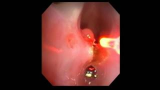 Posterior Glottic Stenosis using UPD with Fiber Dr Fink [upl. by Yerahcaz]