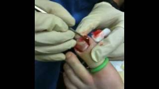 Performing an Ingrown toenail surgery with cauterization of granuloma Day 1 [upl. by Nalda266]