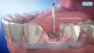 Implante Pilar y Corona  OralB [upl. by Orpha]