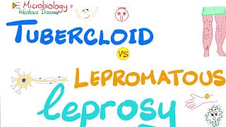 Leprosy  Tuberculoid Leprosy vs Lepromatous Leprosy  Comparisons Playlist [upl. by Cilo]