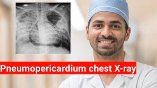 Pneumopericardium in chest Xray [upl. by Khichabia73]