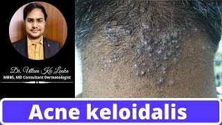 Reason and Treatment of pimples on neckback side of headAcne keloidalis  By MBBS Dr Uttam Lenka [upl. by Morganica113]