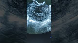 Endometrial polyp ultrasound [upl. by Rufina]