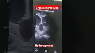 Cranial ultrasound showing rapidly progressive postmeningitic hydrocephalus in a preterm neonate [upl. by Radburn45]