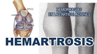 HEMARTROSIS  HEMORRAGIAS EN UNA ARTICULACIÓN [upl. by Salokin911]