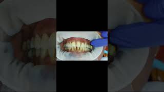 40 micron clearance and 80 micron resistance test for bilateral first molar implant crown GCam [upl. by Willumsen]