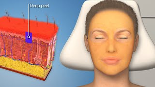 Deep Chemical Peel The most powerful and dangerous skin treatment you can get [upl. by Sackman]