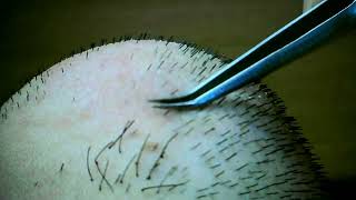 Facial hair removal with tweezers 6 ピンセットを使った顔の毛抜き [upl. by Aurelius]