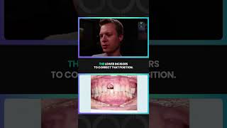 Using Aligners to Achieve a Successful Implant 🦷 [upl. by Aihsotal]