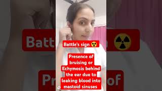 classical sign of Basilar skull fracture Battles sign ☢️ ampRacoons sign 🛑medicalstudent [upl. by Nereids205]