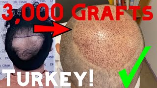 My Second Hair Transplant in Istanbul Turkey  3000 Grafts  Dr Cinik Clinic [upl. by Edvard80]