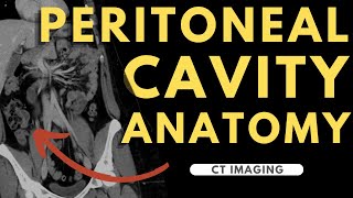 Peritoneal cavity abdominal organs and spaces  Radiology anatomy part 1 prep  CT abdomen [upl. by Ahsinak332]