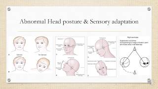 Paralytic squint and its clinical features [upl. by Nnaaihtnyc471]