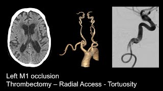 Stroke  Left M1 occlusion Radial  Tortuous 1x [upl. by Eenet]