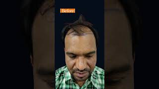 Hair Transplant 4700 Grafts 😱💇‍♂️  Dr Soumy Panday  Rootz Hair Transplant Clinic Raipur [upl. by Harmonia]