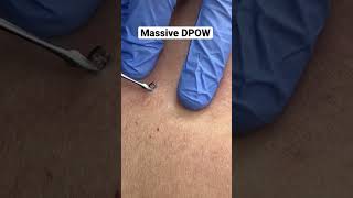 Massive DPOW Removal [upl. by Melise]