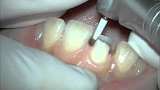 Tooth preparation for Allceramic crown by fourthmolarcom [upl. by Isman236]