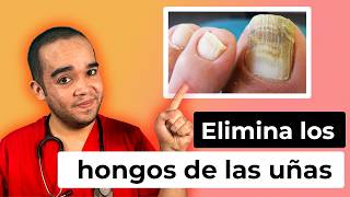 CÓMO QUITAR HONGOS DE LAS UÑAS  ONICOMICOSIS [upl. by Stent]