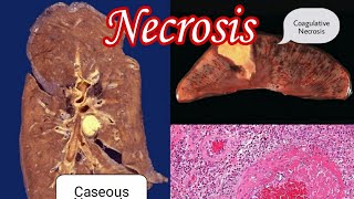 Necrosis  Types of Necrosis  MisMedicine [upl. by Dilly234]